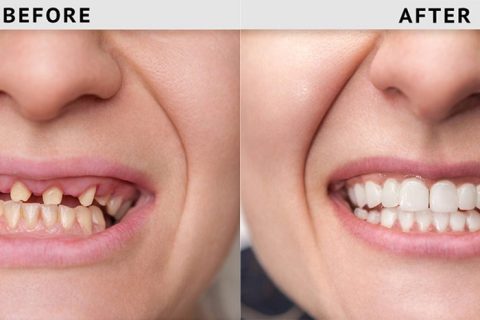 From Provisional To Final Restorations Timeline Of An Implant Smile