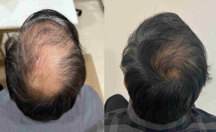Benefit and Risk Hair Transplant