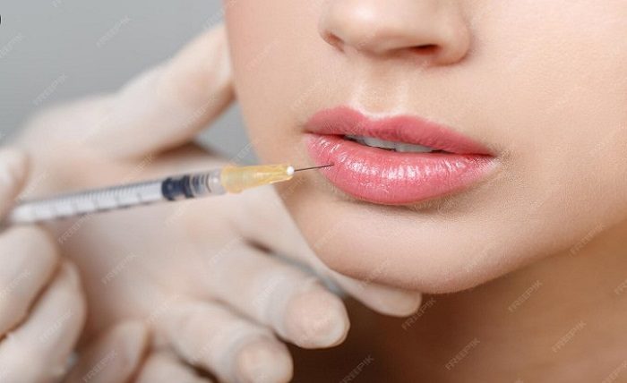 Lip Filler Before and After Overview